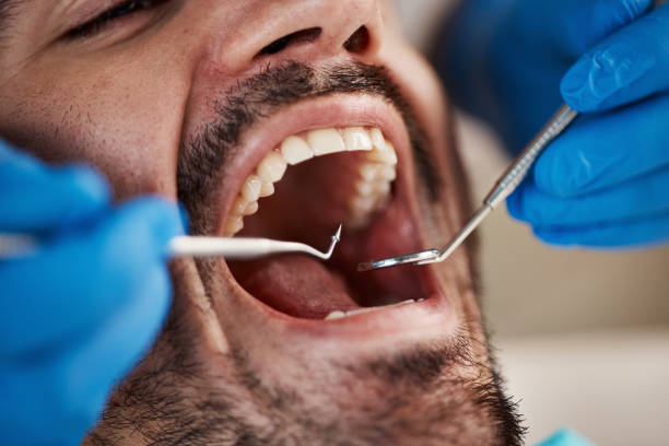 Best Emergency Dental Care for Broken or Chipped Teeth in Durham, CA